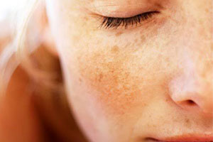 What is hyperpigmentation?